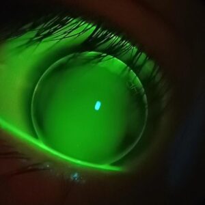 Lentes de contacto Rígidos