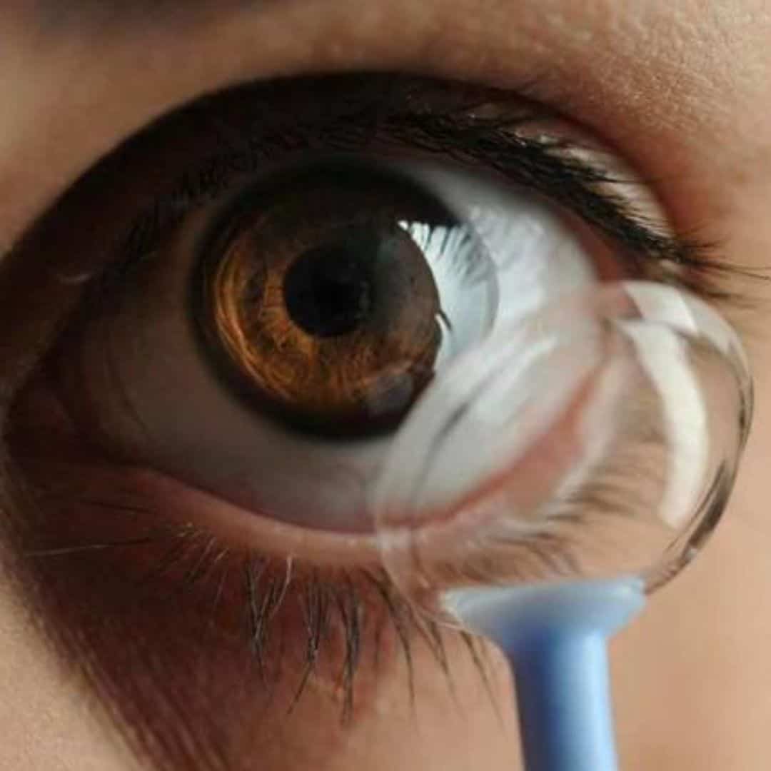 lentes para queratocono